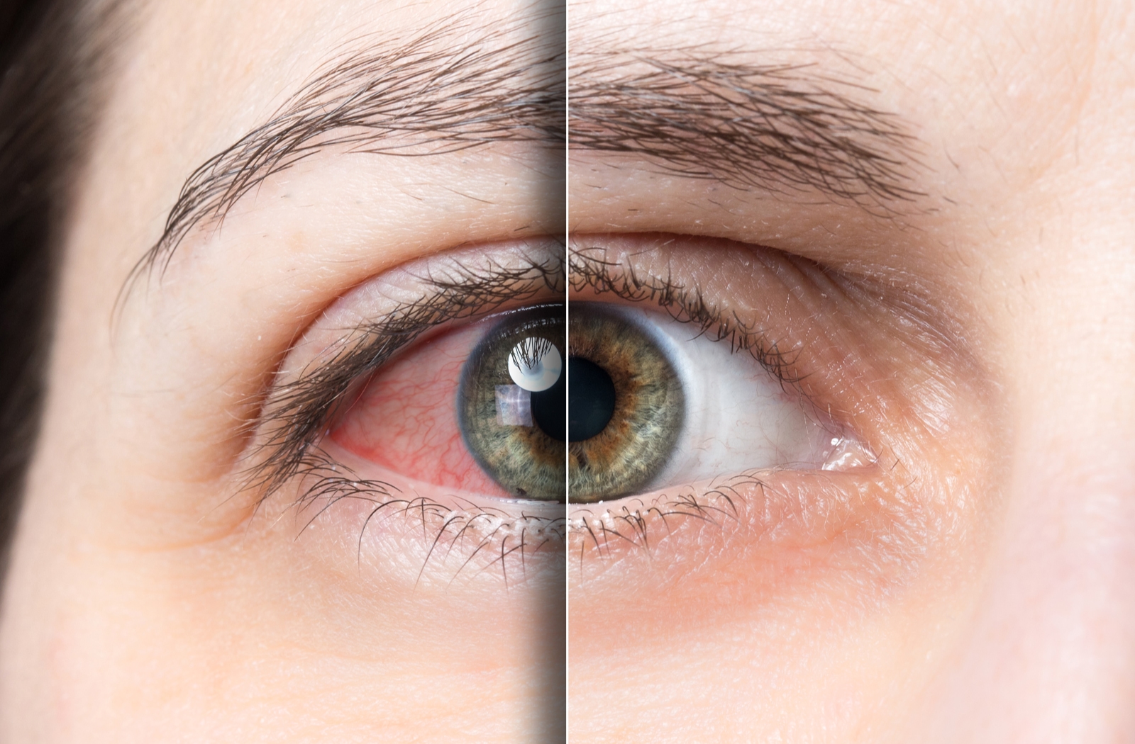 Close up image of an eye with a line drawn over, showing red dry eye on the left, and a normal eye on the right.