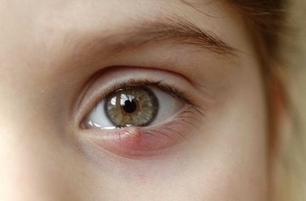 Up close image of a patient's eye with stye on the bottom eyelid.
