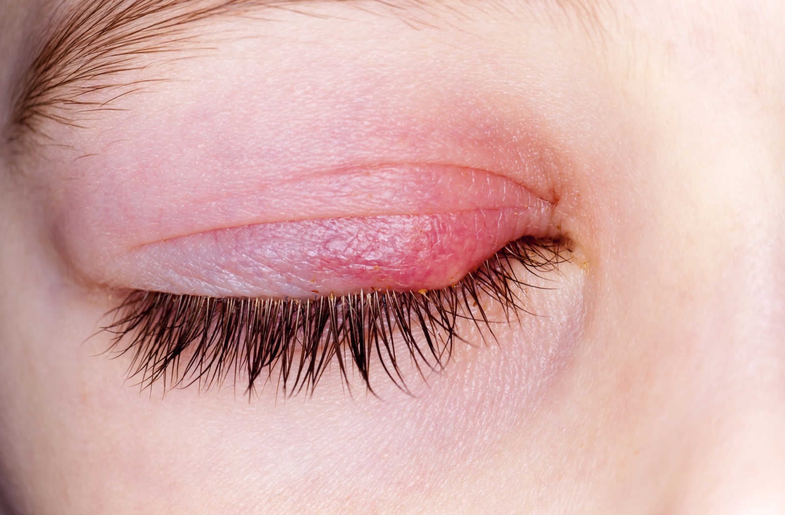 Up close image of a patient's closed eye with stye on the upper eyelid.