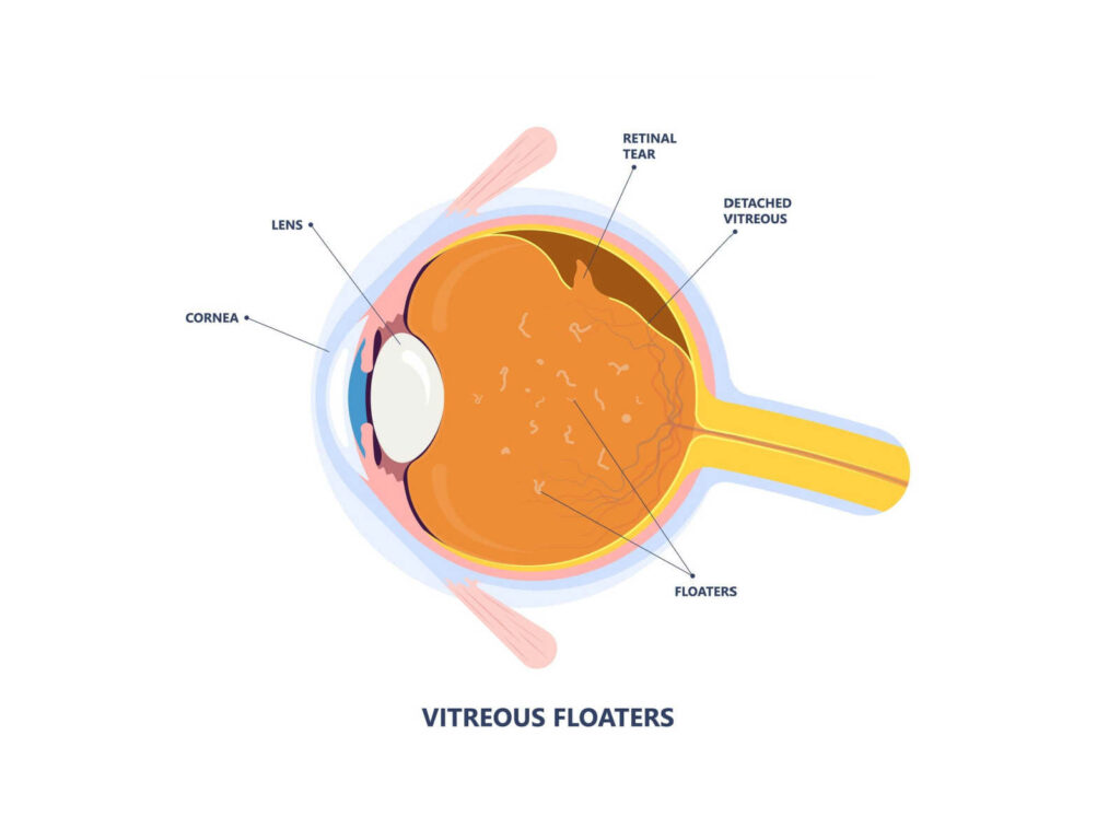 Drawn cross section of an eye showing a retinal tear and detached vitreous.